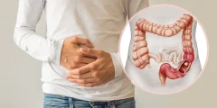 القولون العصبي | Irritable Bowel Syndrome (IBS)