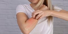 حساسية الجلد | Skin Allergy