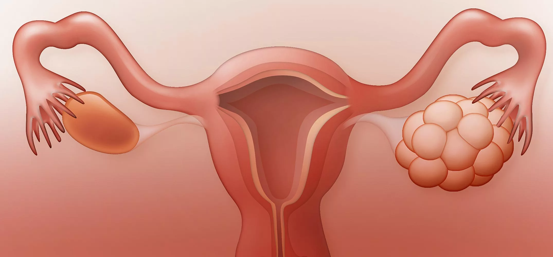 كيس المبيض | Ovarian Cyst