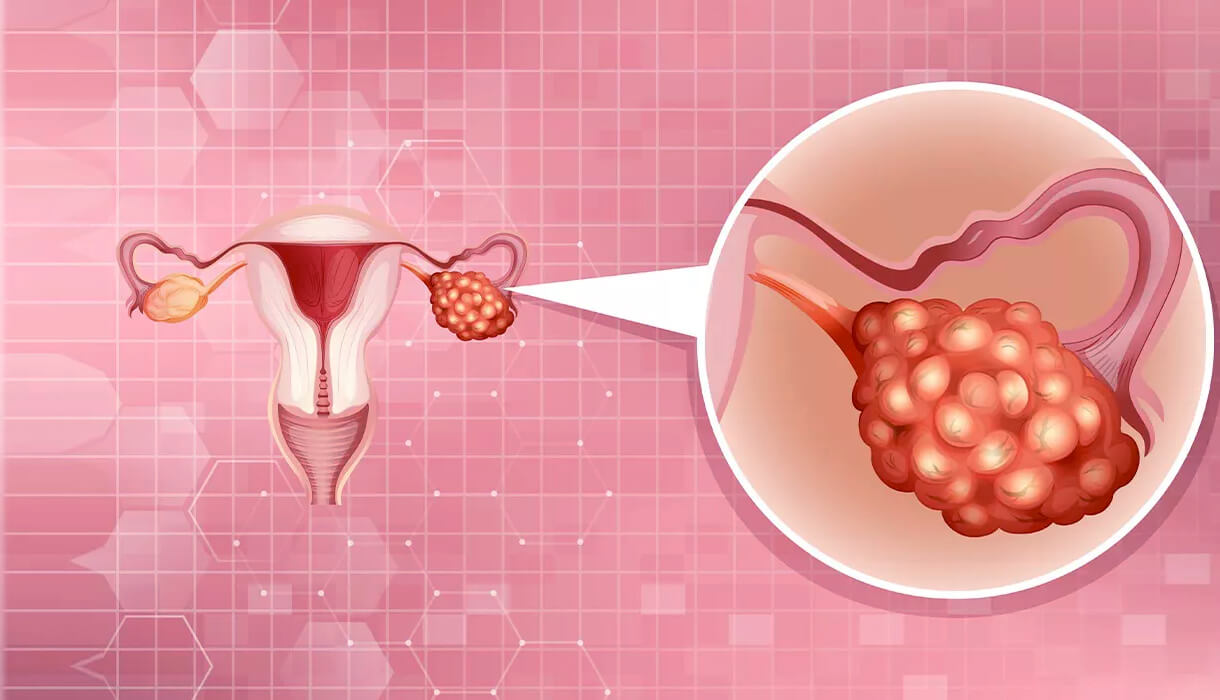 كيس المبيض | Ovarian Cyst  