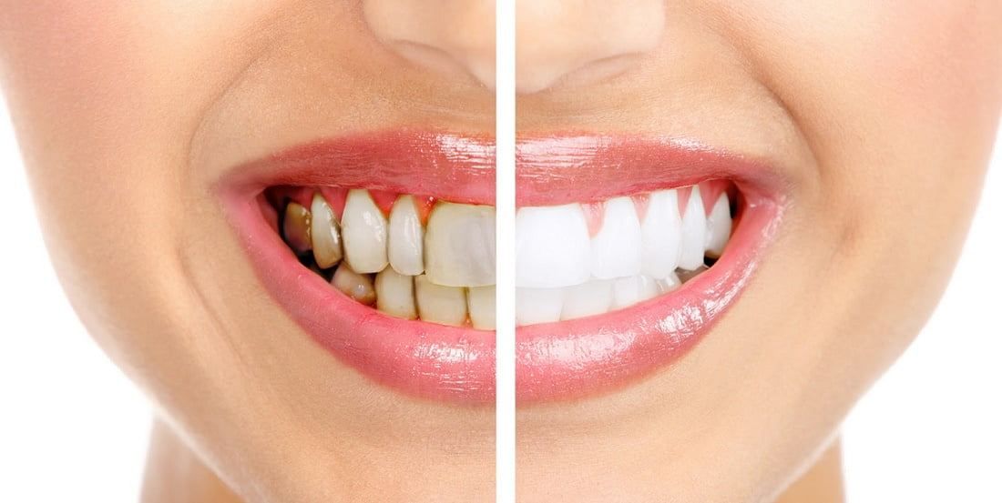 ما هو شكل جير الاسنان بالصور؟ وهل يمكن إزالته بالمنزل؟