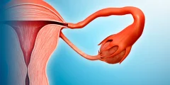 ما هو التواء المبيض؟ الأسباب والأعراض وطرق العلاج للحفاظ على خصوبتك