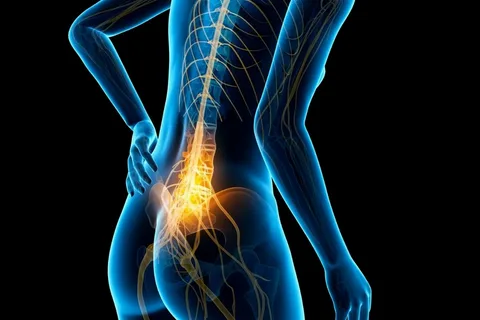 ما هي أعراض عرق النسا؟ الدليل الشامل للتشخيص والعلاج