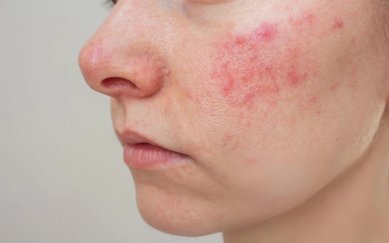 ما هي الذئبة الحمراء؟ الأسباب، الأعراض، التشخيص وأحدث طرق العلاج