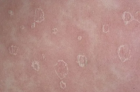 ما هي التينيا؟ أسبابها وأعراضها وكيف تميزها عن الأمراض الجلدية المشابهة