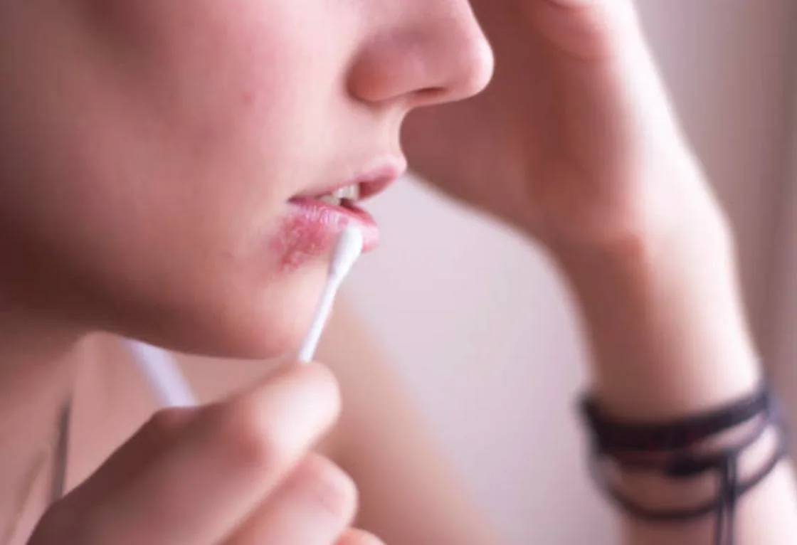 ما هو الهربس الفموي؟ وما أسبابه وأعراضه وطرق العلاج والوقاية منه؟