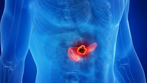 ما هي أعراض سرطان البنكرياس وما علاقته بالسكري وكيف يمكن الوقاية منه؟