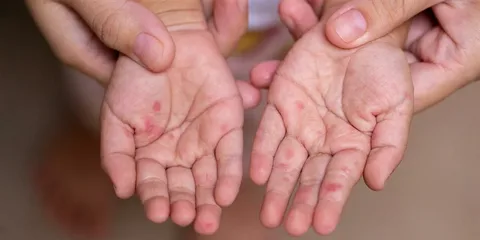 ما هو مرض اليد والقدم والفم؟ الأسباب، الأعراض وطرق الوقاية من العدوى