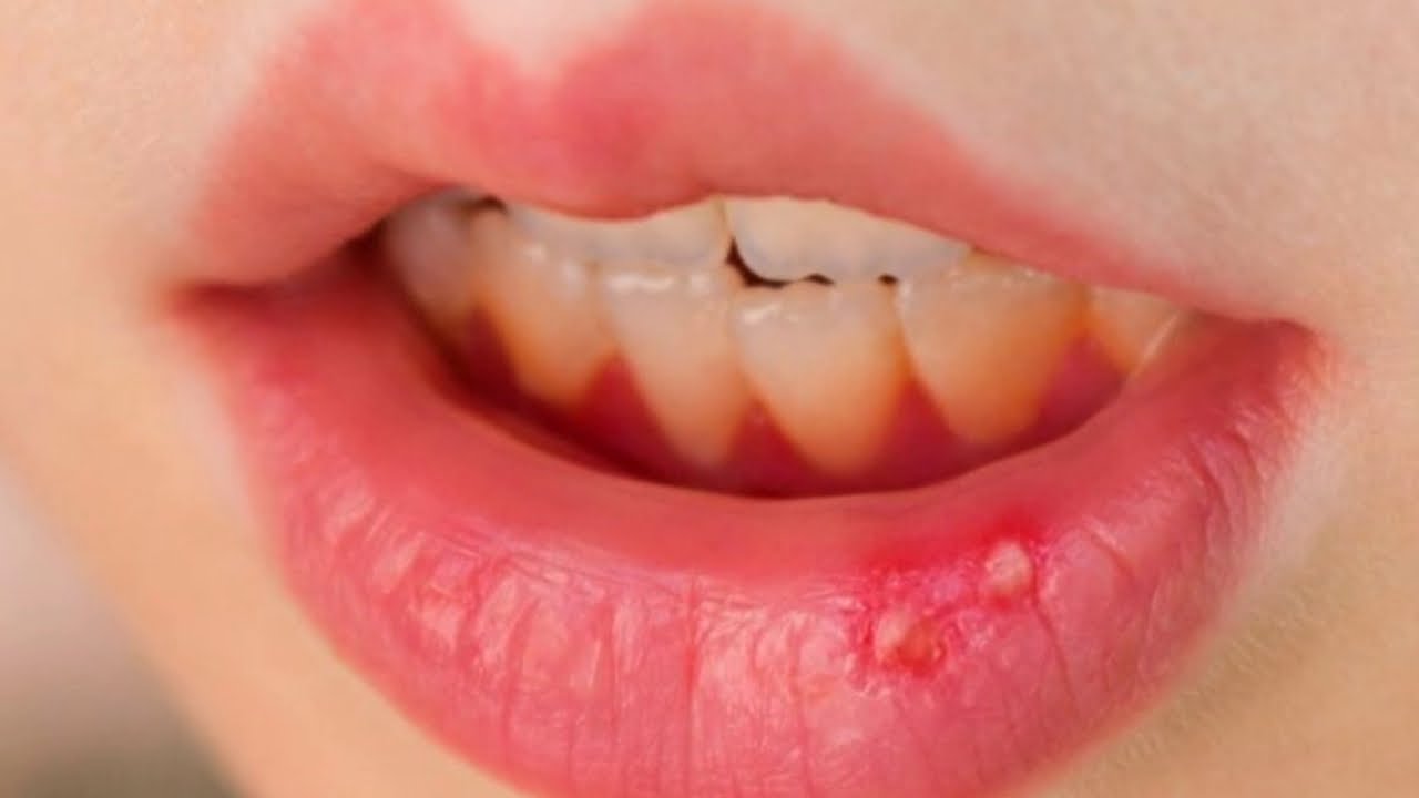 ما هو الهربس الفموي؟ وما أسبابه وأعراضه وطرق العلاج والوقاية منه؟