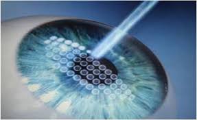 نسبة نجاح عملية الفيمتو ليزك