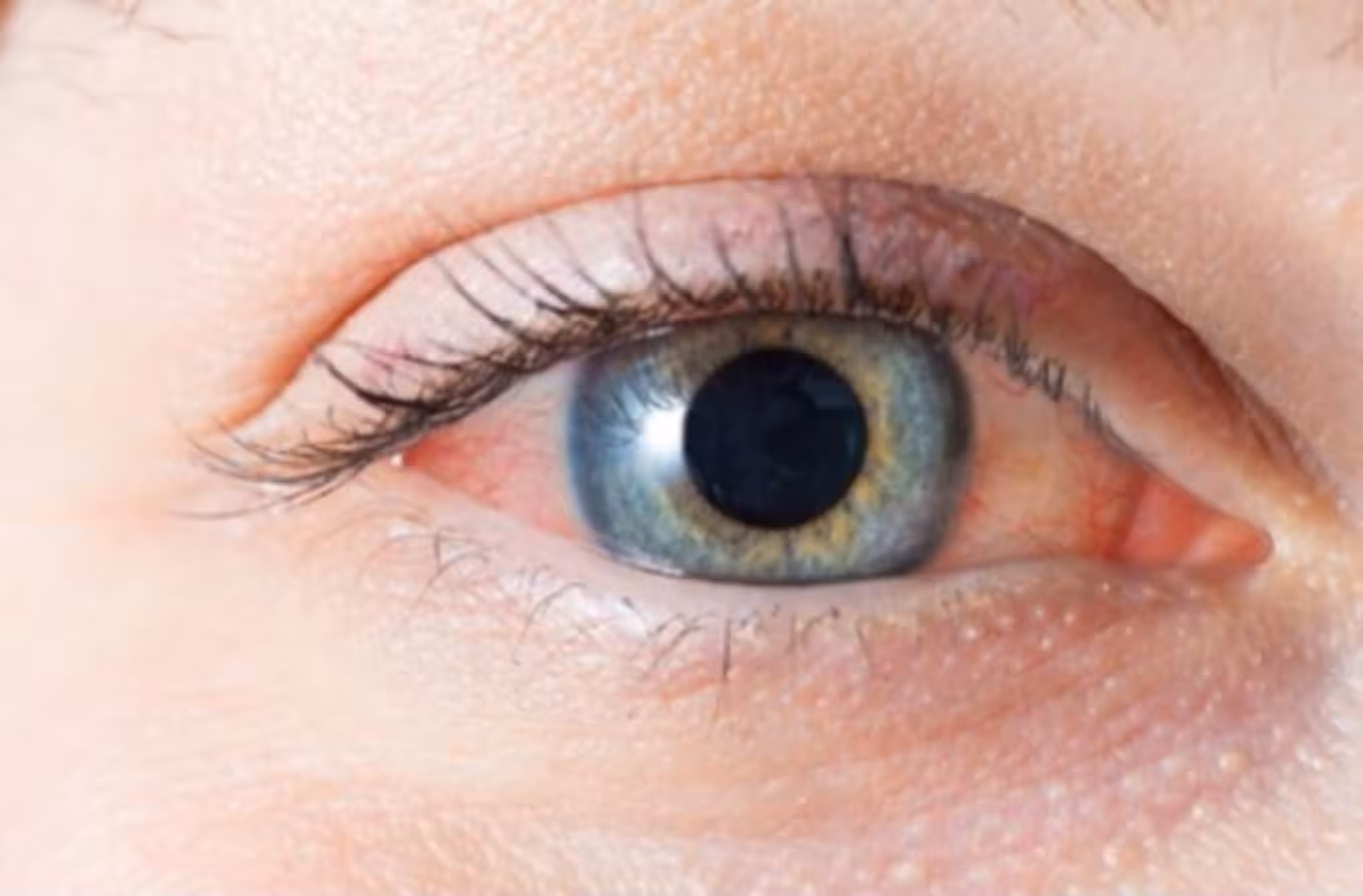 ما هو الرمد (التهاب الملتحمة)؟ أسبابه،أنواعه،طرق العلاج والوقاية
