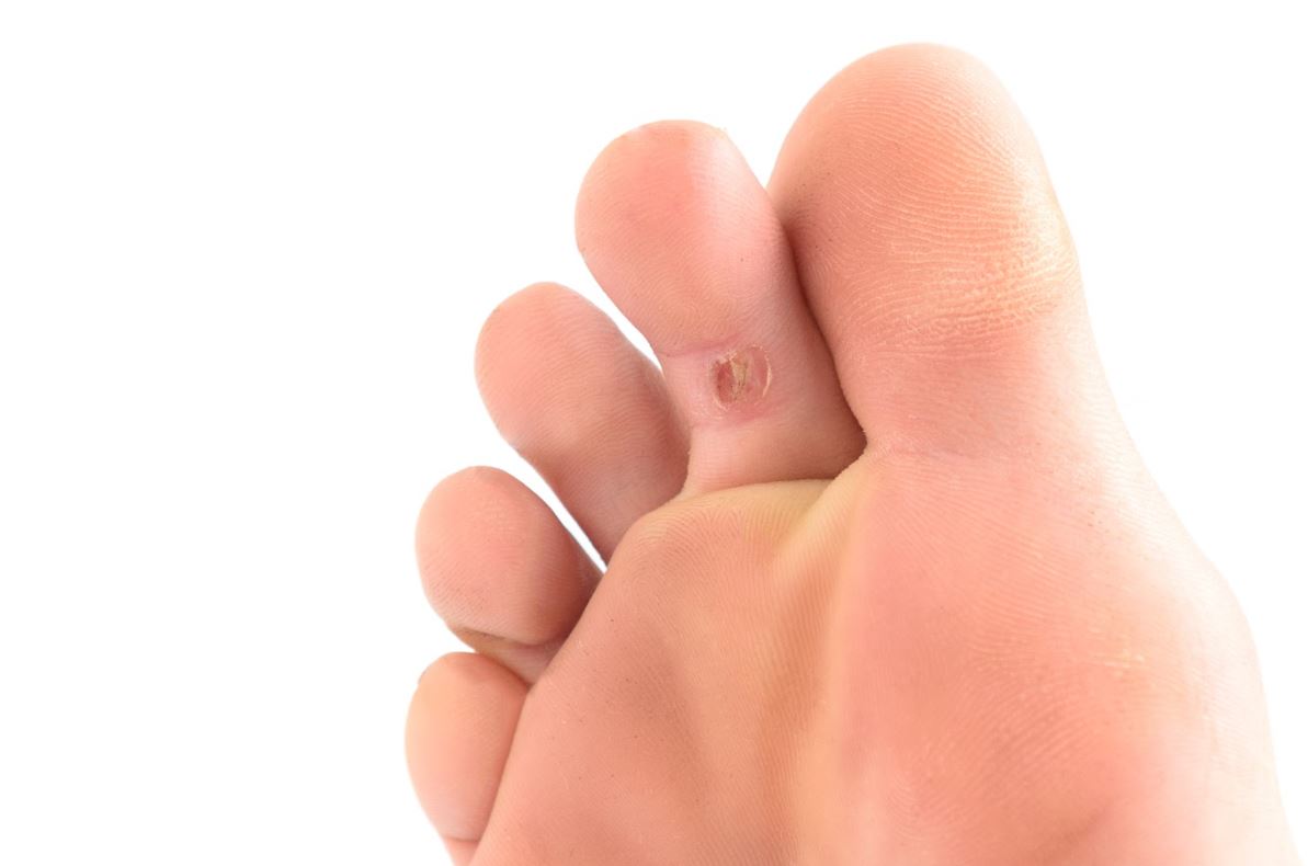 ما هو مسمار القدم؟ أسبابه، الفرق بينه وبين الكالو، وطرق العلاج