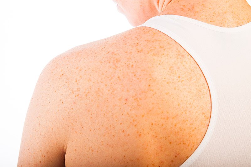 ما هي أفضل طريقة لعلاج تصبغات الظهر؟ وما هي أسباب سواد الظهر؟