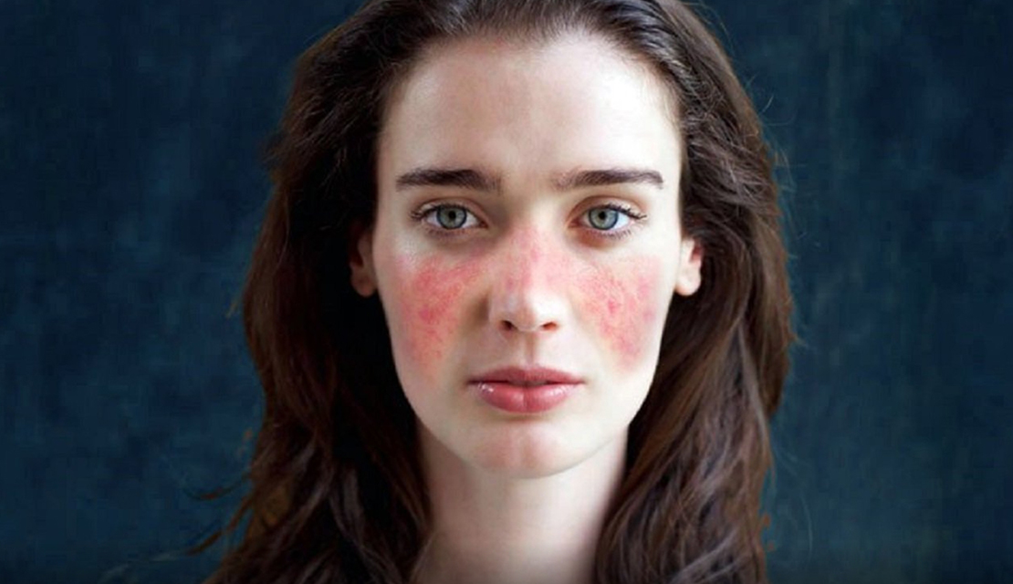 ما هو مرض الذئبة الحمراء؟ يُعد مرض الذئبة الحمراء من الأمراض المناعية المزمنة التي تُثير الكثير من التساؤلات؛ فهو مرض معقد ومتعدد الأنواع، تختلف أعراضه وحدّته من شخص لآخر، وقد يؤثر على أجزاء عديدة من الجسم مثل الجلد والمفاصل والكلى والدماغ والقلب. ينتمي هذا المرض إلى فئة أمراض المناعة الذاتية، حيث يختل الجهاز المناعي ويهاجم أنسجة الجسم بدلًا من محاربة البكتيريا والفيروسات. هذا الهجوم الخاطئ يؤدي إلى حدوث التهابات وتلف في الأعضاء المصابة، مما يجعل الذئبة الحمراء مرضًا طويل الأمد يحتاج إلى رعاية طبية مستمرة. في هذا المقال سنستعرض بشكل مبسط ما هو مرض الذئبة الحمراء، وما أسبابه المحتملة، وكيف تظهر أعراضه على الجسم، إضافة إلى طرق تشخيصه وعلاجه وكيفية التعايش معه. كما سنقدم نصائح عملية تساعد المرضى على السيطرة على المرض وتقليل flare-ups أو نوبات نشاطه المفاجئة. ما هو مرض الذئبة الحمراء؟ الذئبة الحمراء أو Systemic Lupus Erythematosus هي اضطراب مناعي ذاتي مزمن، يحدث عندما يتعامل الجهاز المناعي مع خلايا الجسم السليمة وكأنها أجسام غريبة، فيبدأ بمهاجمتها. يؤدي هذا الخلل المناعي إلى حدوث التهابات بدرجات متفاوتة في مختلف أعضاء الجسم. يعد هذا النوع هو الأكثر شيوعًا بين أنواع الذئبة، وهو النوع الذي غالبًا يُقصد به عند الحديث عن المرض. تتميز الذئبة بأنها مرض متعدد الأعراض، وقد تُصيب أجهزة عدة في نفس الوقت. كما أن شدة المرض قد تتراوح بين خفيفة ومعتدلة، بينما يعاني البعض من حالات شديدة تحتاج إلى متابعة طبية دقيقة. قد تمر الذئبة بنوبات نشاط وأخرى من الهدوء، حيث قد تشتد الأعراض في مرحلة معينة ثم تهدأ لفترة طويلة. أنواع مرض الذئبة الحمراء يظهر المرض بعدة أشكال تختلف في طبيعتها ودرجة خطورتها، ومن أبرز أنواعه: الذئبة الحمراء الجهازية وهي النوع الأكثر انتشارًا وخطورة، لأنها قد تؤثر على العديد من أعضاء الجسم بما في ذلك الكلى والقلب والرئتين والدماغ والمفاصل والجلد. الذئبة الجلدية تُصيب الجلد بشكل مباشر، وقد تظهر على شكل طفح جلدي دائري أو على شكل فراشة على الخدين والأنف. هناك أنواع فرعية من الذئبة الجلدية مثل الذئبة القرصية والذئبة تحت الحادة. الذئبة الناتجة عن الأدوية يمثل هذا النوع استجابة مناعية لبعض الأدوية، ويشبه في أعراضه الذئبة الجهازية ولكنه أقل خطورة. غالبًا تختفي الأعراض بعد التوقف عن الدواء المسبب. الذئبة لدى الأطفال تظهر في سن مبكرة، وتكون عادةً أشد من النوع الذي يصيب البالغين، وتتطلب متابعة دقيقة بسبب تأثيرها على نمو الطفل. ما هي أسباب مرض الذئبة الحمراء؟ حتى الآن لم يستطع العلماء تحديد سبب واحد مباشر للذئبة الحمراء، ولكن هناك عدة عوامل يُعتقد أنها تسهم في ظهور المرض. هذه العوامل قد تتداخل معًا، وكل منها يلعب دورًا في تعطيل الجهاز المناعي وجعله يهاجم أنسجة الجسم. العوامل الوراثية تُشير الدراسات إلى وجود تاريخ عائلي للمرض عند بعض المصابين، وهذا يعني أن الاستعداد الجيني قد يلعب دورًا مهمًا. لكن هذا لا يعني بالضرورة أن الإصابة تنتقل مباشرة من جيل لآخر، بل قد تكون هناك جينات تزيد من القابلية للإصابة. العوامل البيئية هناك محفزات قد تدفع الجهاز المناعي للدخول في حالة من النشاط الزائد، ومنها: – التعرض الطويل لأشعة الشمس – العدوى الفيروسية – الضغوط النفسية الشديدة – التعرض لمواد كيميائية معينة الهرمونات يُلاحظ أن المرض أكثر انتشارًا بين النساء، خصوصًا في سن الإنجاب، مما يُشير إلى أن للهرمونات الأنثوية دورًا في زيادة احتمالية الإصابة. الأدوية بعض الأدوية قد تسبب الذئبة الدوائية، ومن أمثلتها بعض أدوية ضغط الدم ومضادات الاختلاج. ما هي أعراض مرض الذئبة الحمراء؟ يُعرف مرض الذئبة الحمراء بتعدد الأعراض واختلافها بين المرضى. قد يعاني المريض من أعراض خفيفة، بينما يعاني آخرون من أعراض شديدة تؤثر على جودة الحياة. من بين أكثر الأعراض شيوعًا: التعب والإرهاق العام يُعد الشعور المستمر بالتعب من أكثر الأعراض شيوعًا، وقد يكون شديدًا لدرجة يؤثر على أداء الأنشطة اليومية. الطفح الجلدي من أبرز الأعراض ظهور طفح جلدي يشبه شكل الفراشة على الخدين والأنف. كذلك قد تظهر بقع حمراء على مناطق مختلفة من الجسم. آلام وتيبس المفاصل يشعر المريض بألم وانتفاخ في المفاصل، خصوصًا في اليدين والقدمين، ويزداد الألم في الصباح. الحمى المتكررة قد يعاني المريض من ارتفاع بسيط بدرجة الحرارة دون سبب واضح. تساقط الشعر يؤدي التهاب فروة الرأس إلى ضعف بصيلات الشعر، وبالتالي تساقطه. مشاكل الكلى تُعد من أخطر أعراض الذئبة، حيث قد تسبب التهابًا في الكلى يصل إلى فشل كلوي في الحالات الشديدة. مشاكل القلب والرئة قد يظهر التهاب في بطانة القلب أو الرئة، ما يسبب ألمًا في الصدر وصعوبة في التنفس. اضطرابات الجهاز العصبي مثل الصداع الشديد، والدوخة، والاكتئاب، وفقدان التركيز. مشاكل الدم تشمل نقص الصفائح الدموية أو فقر الدم أو زيادة احتمالية حدوث الجلطات. كيف يتم تشخيص الذئبة الحمراء؟ لأن أعراض الذئبة قد تُشبه أمراضًا كثيرة، فإن التشخيص يعتمد على مجموعة من الفحوصات وليس فحصًا واحدًا. يشمل التشخيص عادة: الفحص السريري يقوم الطبيب بمراجعة الأعراض وتاريخ المريض الصحي بالتفصيل. تحاليل الدم تشمل تحليل ANA الذي يكشف وجود أجسام مضادة ذاتية، إضافة إلى تحاليل أخرى للكشف عن الالتهابات ونسبة الصفائح الدموية والهيموجلوبين. تحليل البول لتحديد وجود بروتين أو دم في البول، وهو مؤشر على تأثر الكلى. صور الأشعة مثل الأشعة السينية أو الرنين المغناطيسي في حال تأثر القلب أو الرئتين أو المفاصل. خزعة الكلى قد يطلب الطبيب أخذ عينة صغيرة من الكلية عند الاشتباه بمشاكل حادة. طرق علاج مرض الذئبة الحمراء رغم أن الذئبة مرض مزمن لا يوجد علاج نهائي له، إلا أن العلاجات الحديثة ساعدت المرضى في السيطرة على أعراضه ومنع المضاعفات. تعتمد طريقة العلاج على درجة نشاط المرض والأعضاء المتأثرة. الأدوية المضادة للالتهابات تُستخدم لتخفيف آلام المفاصل والعضلات. الكورتيزون يعمل على تقليل الالتهابات بسرعة، ويُستخدم في النوبات الحادة، لكن يجب استخدامه بحذر لتجنب آثاره الجانبية. أدوية تثبيط المناعة تساعد على تقليل نشاط الجهاز المناعي ومنع تلف الأعضاء. الأجسام المضادة البيولوجية تُعد من أحدث العلاجات التي تستهدف أجزاء معينة من الجهاز المناعي وتعمل على تهدئة المرض. الأدوية الخاصة بالكلى في حال وجود التهاب كلوي، تُستخدم علاجات خاصة للسيطرة على الحالة. نصائح للتعايش مع الذئبة الحمراء اتباع نمط حياة صحي يساعد المريض على تقليل الأعراض وتحسين جودة حياته. من أهم النصائح: الابتعاد عن الشمس لأن التعرض للشمس يزيد نشاط المرض وظهور الطفح الجلدي. الحفاظ على نظام غذائي صحي تناول الأطعمة الغنية بمضادات الأكسدة والخضروات والفواكه. ممارسة الرياضة الخفيفة مثل المشي واليوغا للحفاظ على مرونة المفاصل. تقليل الضغوط النفسية الجانب النفسي له تأثير كبير على نشاط المرض. الالتزام بالأدوية وتجنب إيقاف أي دواء دون استشارة الطبيب. إجراء فحوصات دورية لمراقبة أي تغيرات مبكرة في أعضاء الجسم. هل يمكن الشفاء من الذئبة الحمراء؟ الذئبة الحمراء مرض مزمن، لكن يمكن السيطرة عليه بشكل ممتاز من خلال العلاج المناسب والنمط الصحي. كثير من المرضى يعيشون حياة طبيعية إذا تم اكتشاف المرض مبكرًا واتباع خطة العلاج. خاتمة مرض الذئبة الحمراء ليس مرضًا بسيطًا، لكنه أيضًا ليس نهاية المطاف. فبفضل التطور الطبي أصبح التعامل معه أسهل بكثير، وأصبح بإمكان المرضى التعايش معه بشكل طبيعي تقريبًا. أهم ما يحتاجه المريض هو الوعي بالأعراض، وطلب المساعدة الطبية في الوقت المناسب، والالتزام بالعلاج ونمط الحياة الصحي. بهذه الطريقة يمكن للمرضى الحد من المضاعفات والاستمتاع بحياة مستقرة وصحية رغم المرض.