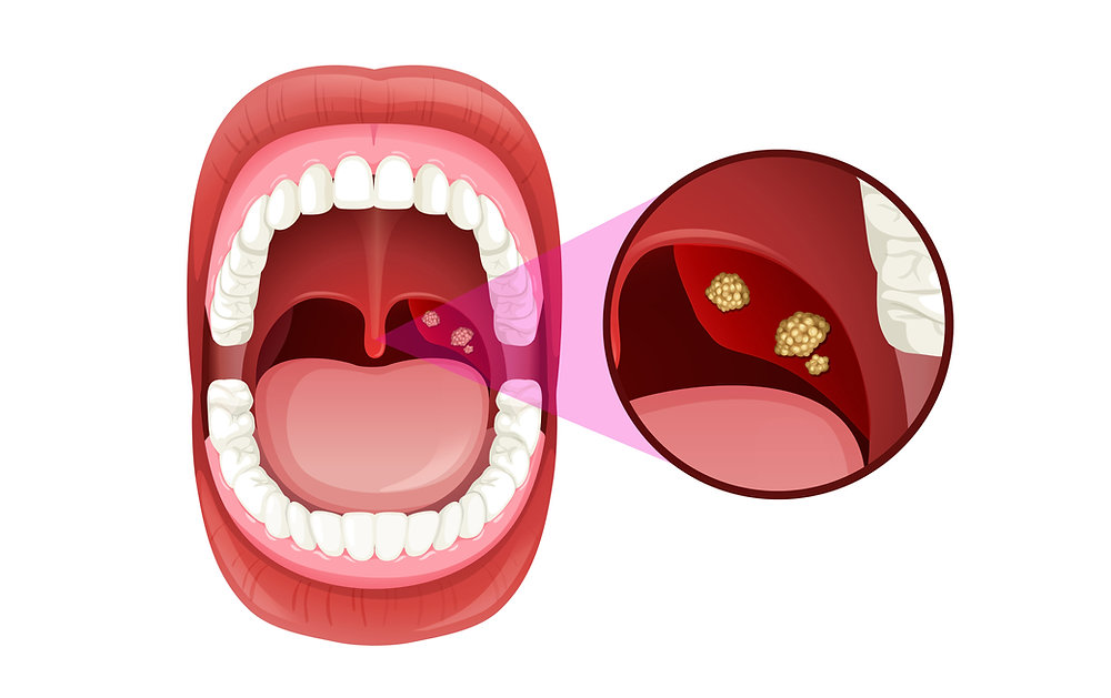 ما هي حصى اللوزتين؟ وما أسبابها وأعراضها وطرق علاجها نهائيًا؟