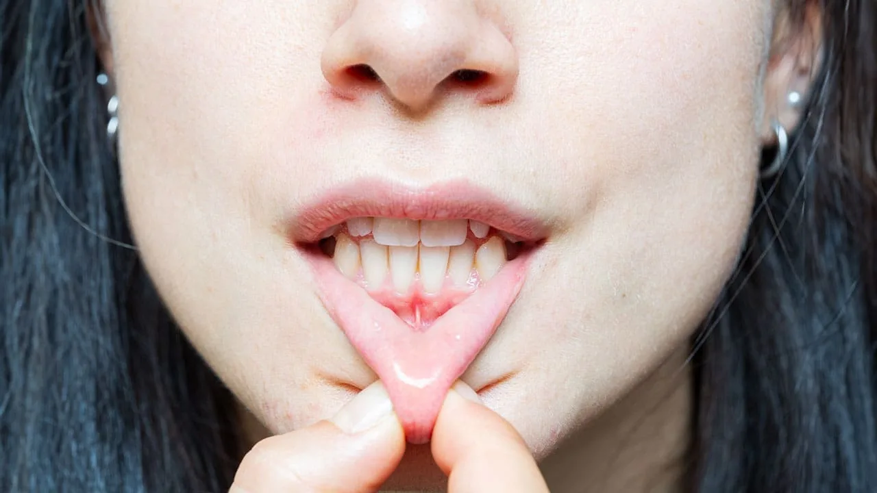 ما هو تراجع اللثة؟ وما أعراضه وأسبابه وكيفية الوقاية منه؟