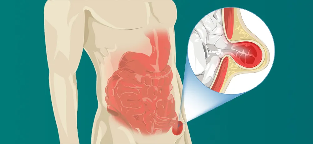 كيف تتم عملية الفتاق وما أهم النصائح قبل وبعد الجراحة؟