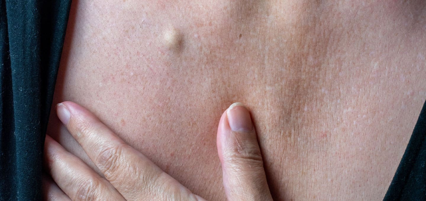 ما هو علاج الكيس الدهني؟ وهل يمكن استئصال الأكياس الدهنية بدون جراحة؟