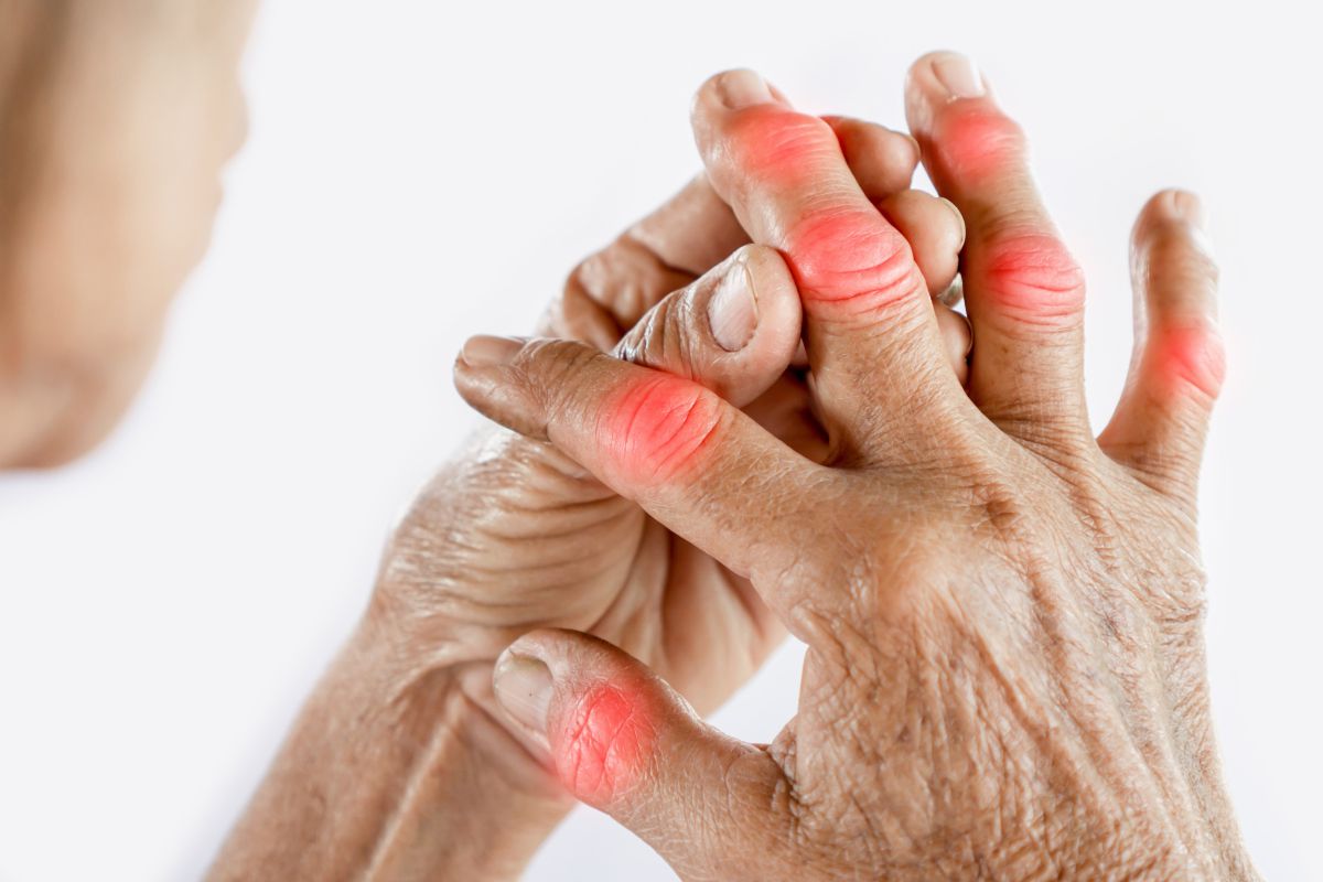 Rheumatoid Arthritis 2