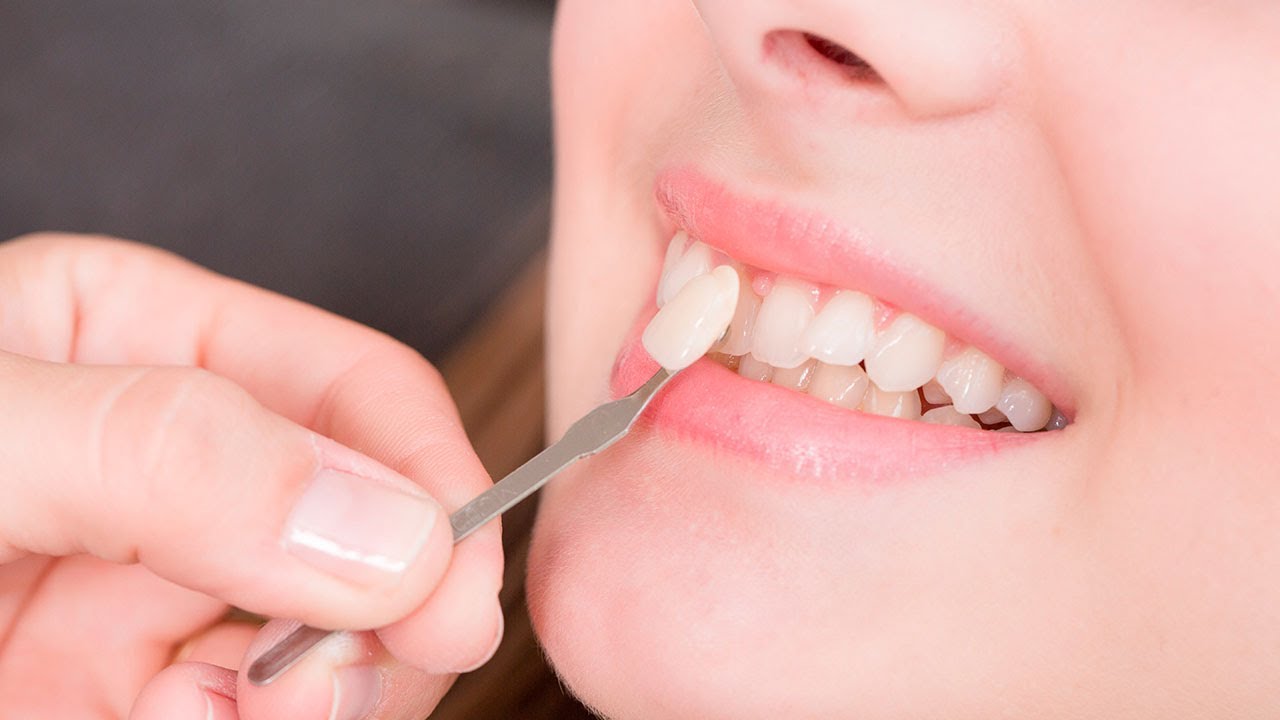 فينير الاسنان: الأنواع والمميزات والعيوب وخطوات التركيب