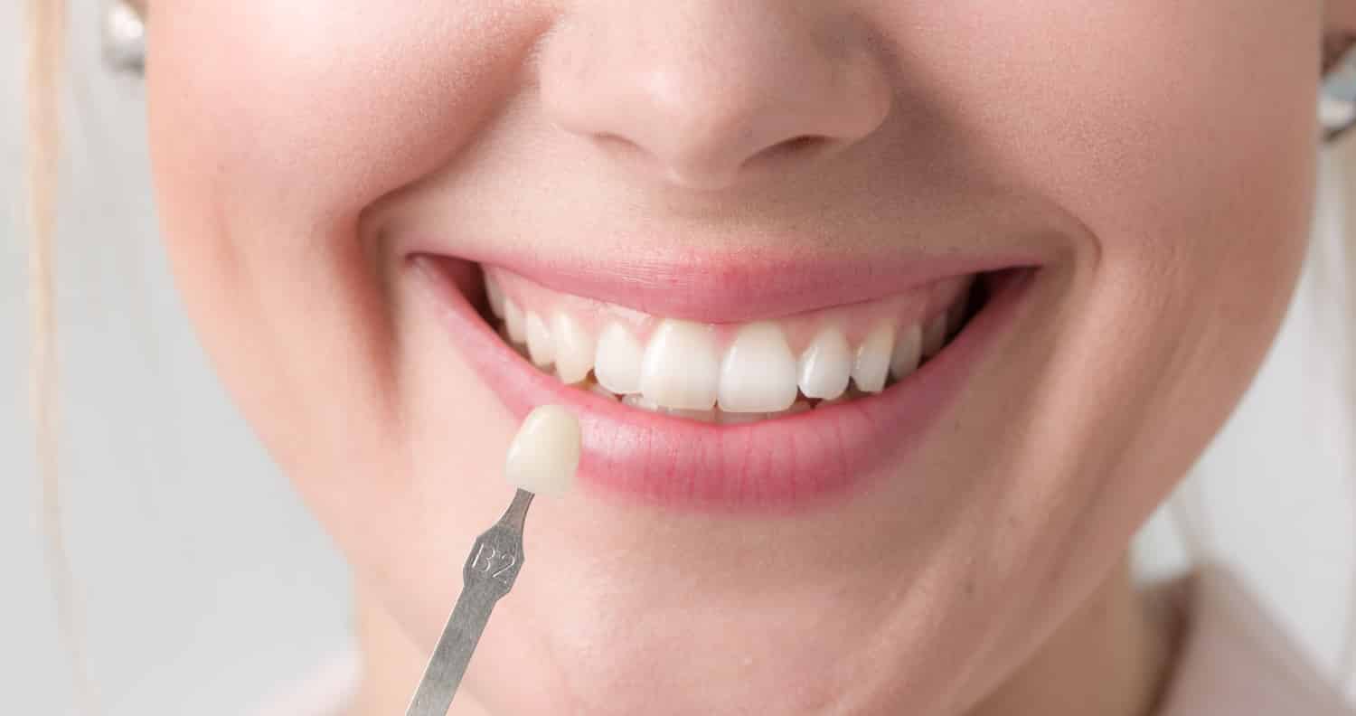 فينير الاسنان: الأنواع والمميزات والعيوب وخطوات التركيب