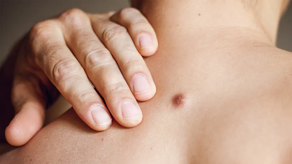 ما هو علاج الكيس الدهني؟ وهل يمكن استئصال الأكياس الدهنية بدون جراحة؟